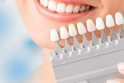 Smile makeover result
