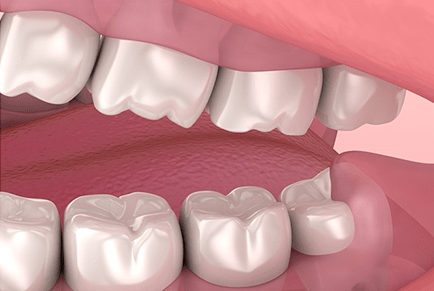 Impacted wisdom tooth illustration