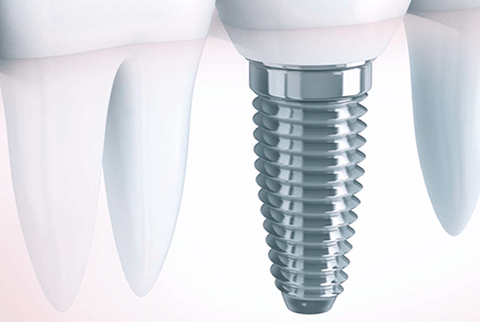 Dental implant before and after